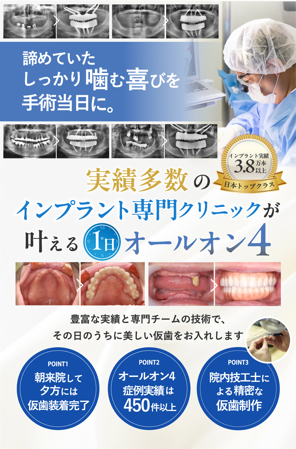 オールオン4（フルマウスインプラント）全ての歯を4本で支える治療